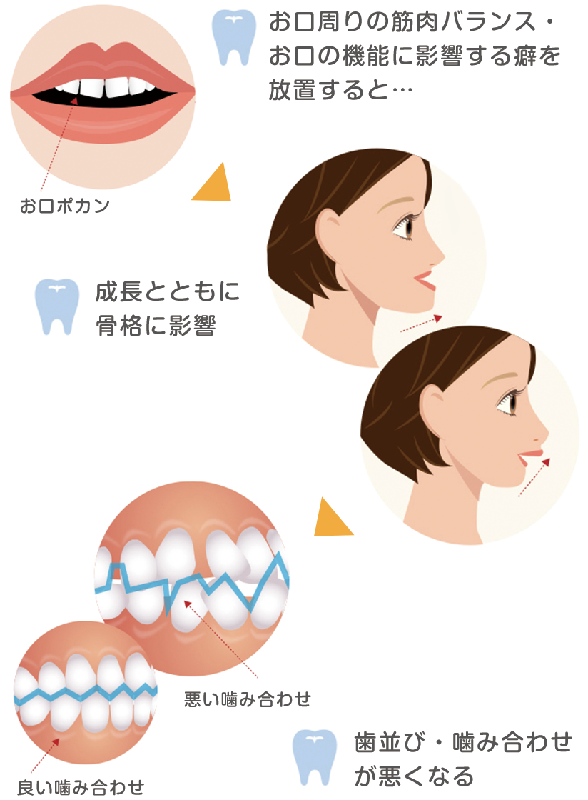 子供のマウスピース矯正 プレオルソ 外せる歯並び治療 京都 ながお歯科クリニック