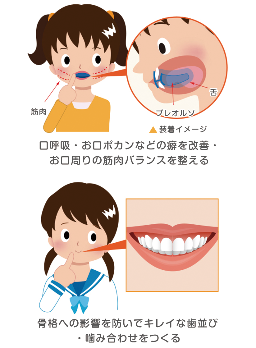 子供のマウスピース矯正 プレオルソ 外せる歯並び治療 京都 ながお歯科クリニック